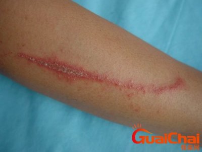 隐翅虫咬人后图片症状 隐翅虫咬人后图片伤口