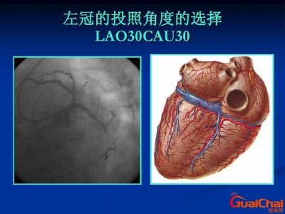 冠状动脉造影怎么做?冠状动脉造影是什么意思